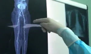 Cô gái mắc hội chứng Madelung phình to vòng ba