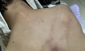 Bé 4 tuổi bị đánh tím lưng ở lớp Bé 4 tuổi bị đánh tím lưng ở lớp
